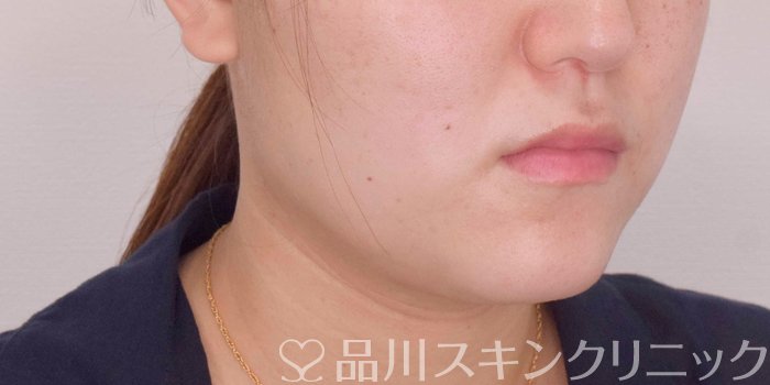 症例NO.68070のAFTER写真