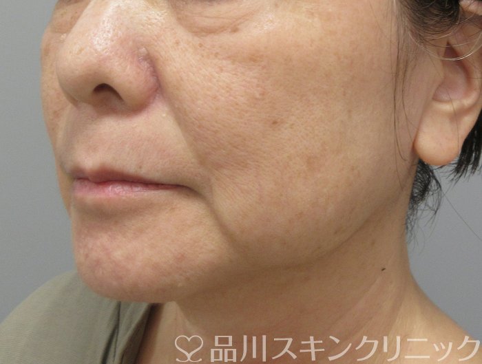 症例NO.74346のBEFORE写真