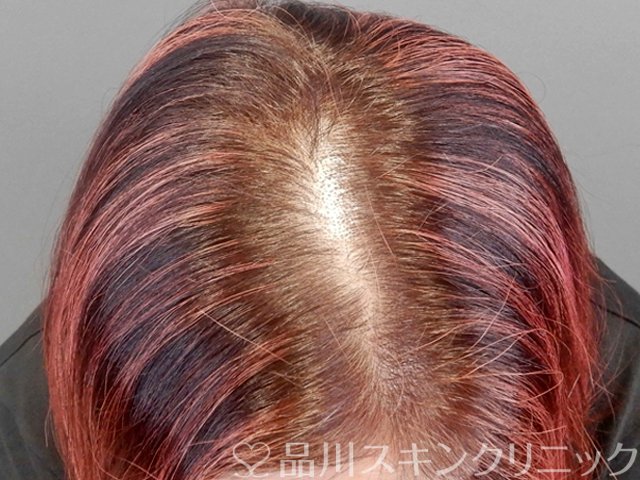 症例NO.69020のBEFORE写真