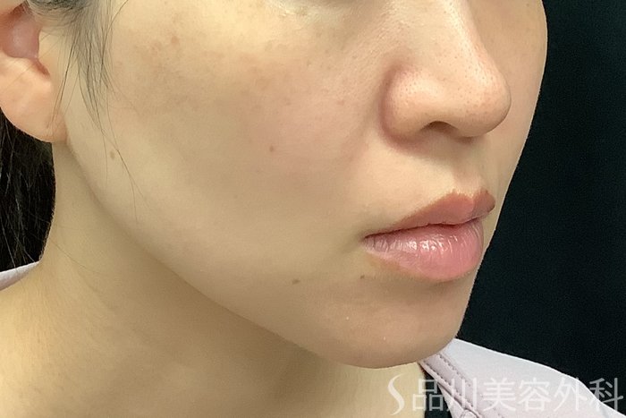 症例NO.71250のBEFORE写真
