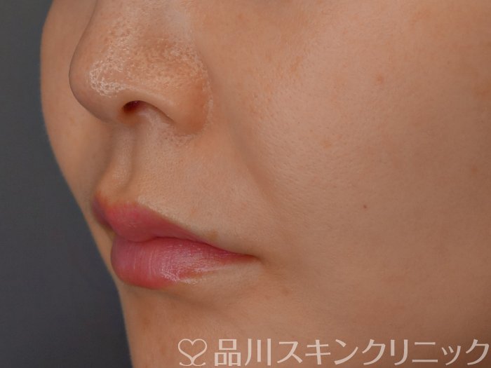 症例NO.72282のBEFORE写真