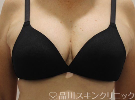 症例NO.72918のAFTER写真