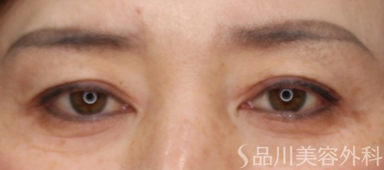 症例NO.75148のBEFORE写真