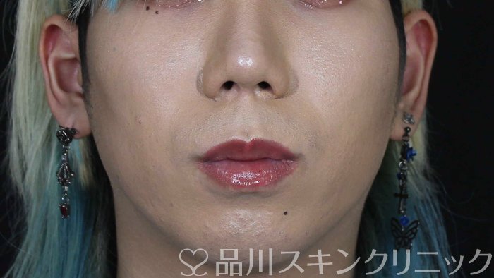 症例NO.71093のAFTER写真