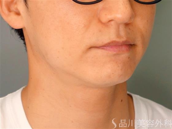症例NO.55347のBEFORE写真