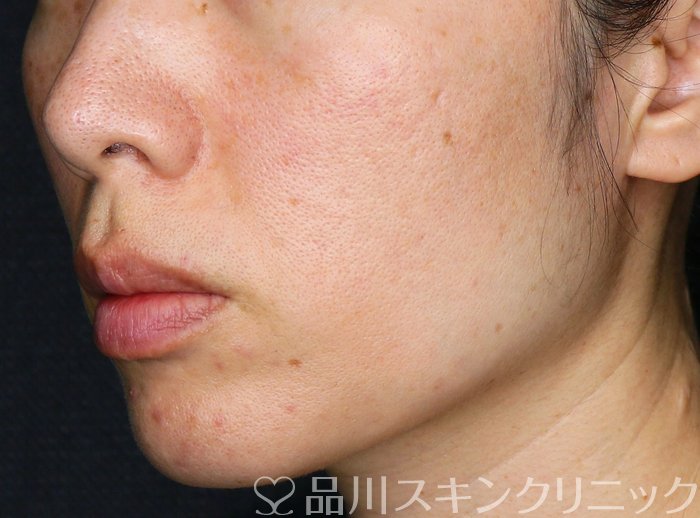 症例NO.75281のBEFORE写真