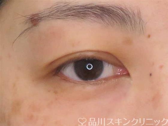 症例NO.61104のAFTER写真