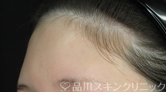 症例NO.69665のAFTER写真