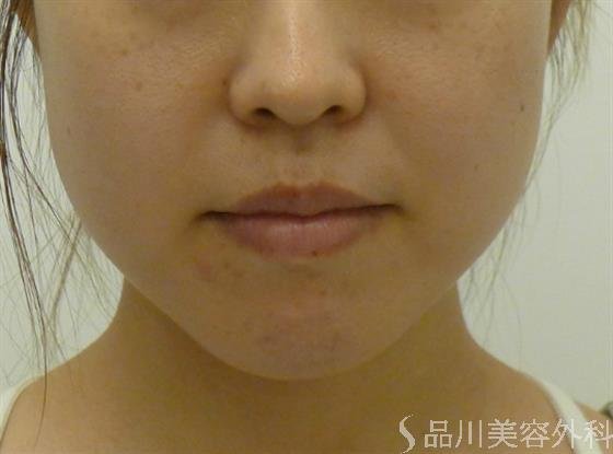 症例NO.34165のBEFORE写真