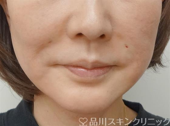 症例NO.45244のAFTER写真