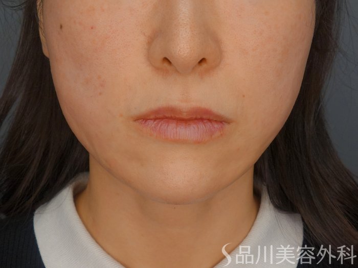 症例NO.72459のAFTER写真