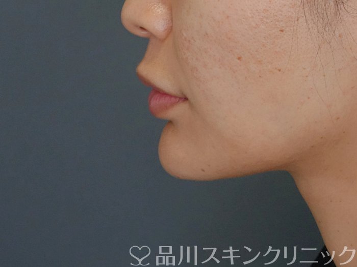 症例NO.72435のAFTER写真