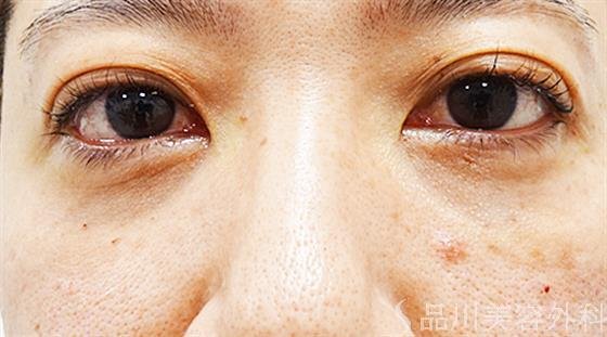 症例NO.48951のAFTER写真