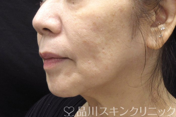 症例NO.74387のBEFORE写真