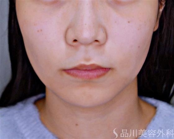 症例NO.53252のBEFORE写真
