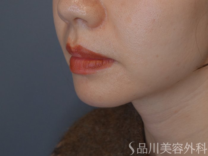 症例NO.72416のBEFORE写真