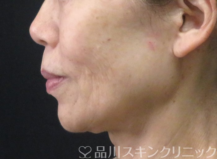 症例NO.70580のBEFORE写真