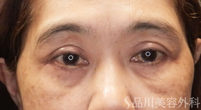 症例NO.65646のAFTER写真