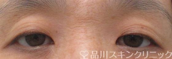 症例NO.26210のBEFORE写真