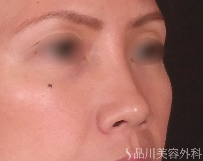 症例NO.69550のBEFORE写真