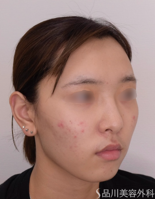 症例NO.68423のBEFORE写真