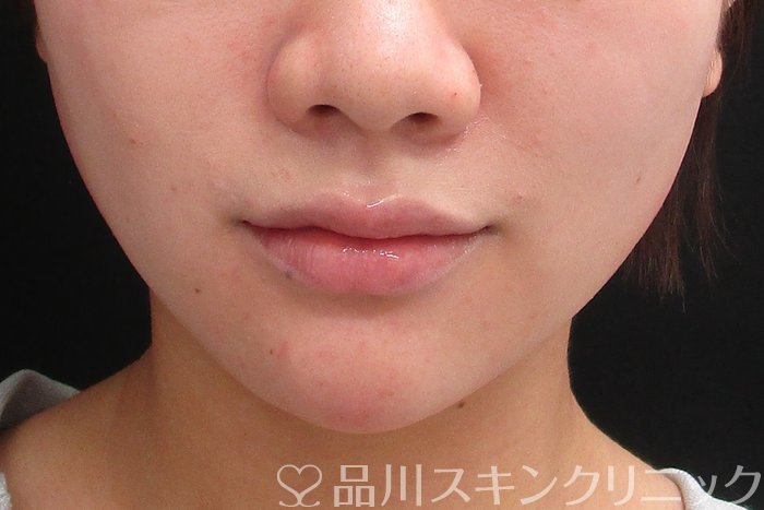 症例NO.74709のAFTER写真