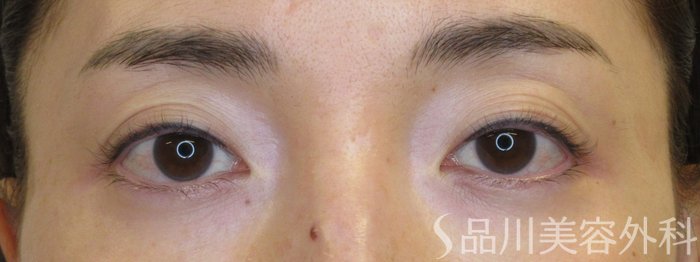 症例NO.72068のBEFORE写真