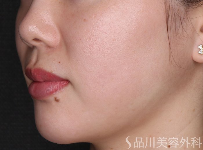症例NO.71683のBEFORE写真