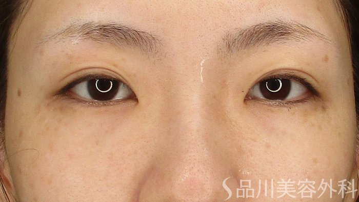 症例NO.67731のAFTER写真