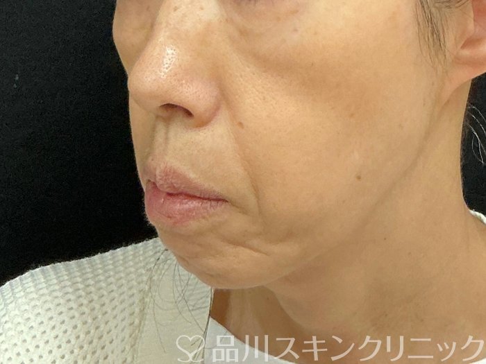 症例NO.74000のBEFORE写真