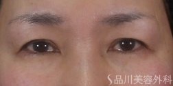 症例NO.74106のBEFORE写真