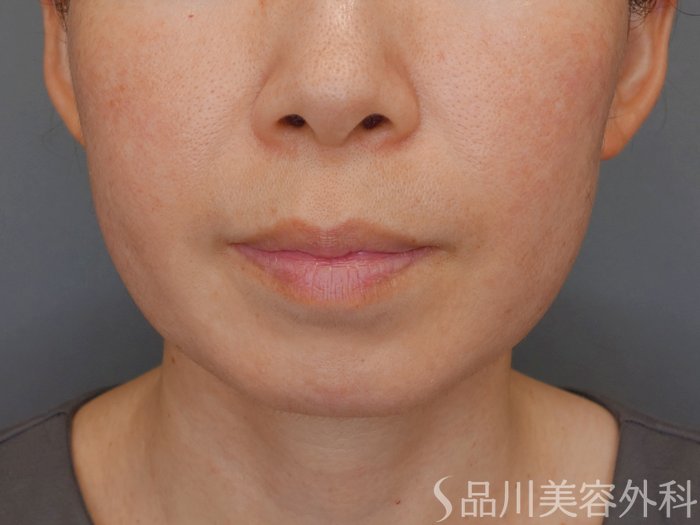 症例NO.70830のBEFORE写真