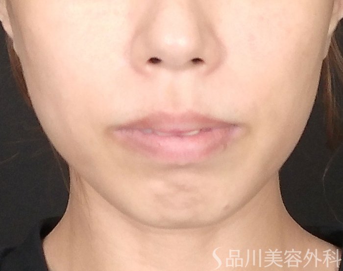 症例NO.69522のBEFORE写真