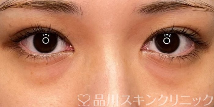 症例NO.68872のBEFORE写真