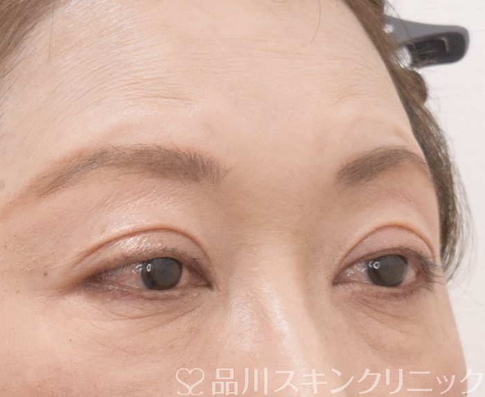 症例NO.74052のAFTER写真