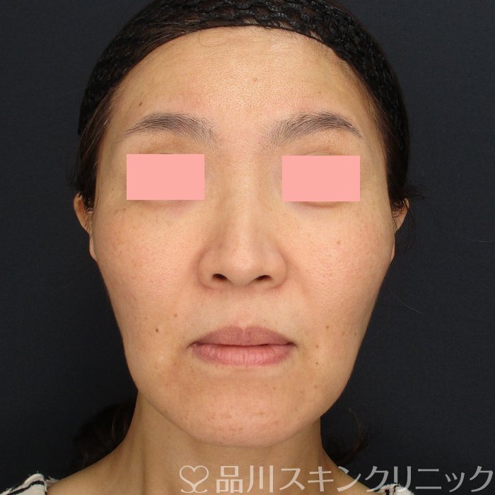 症例NO.72657のBEFORE写真