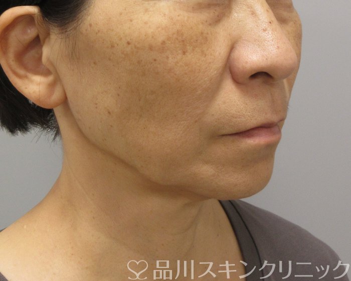 症例NO.73925のBEFORE写真
