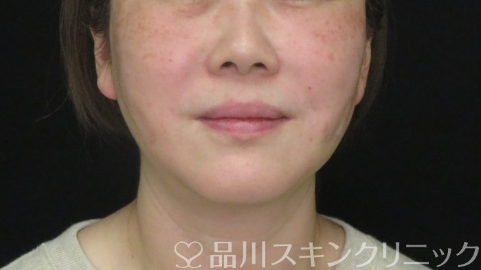 症例NO.73056のAFTER写真