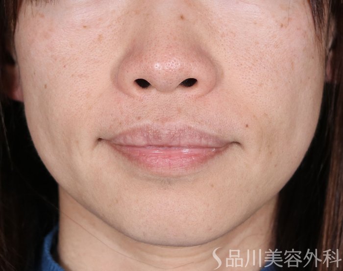 症例NO.72418のBEFORE写真