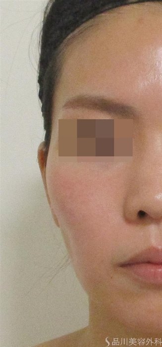 症例NO.55618のBEFORE写真