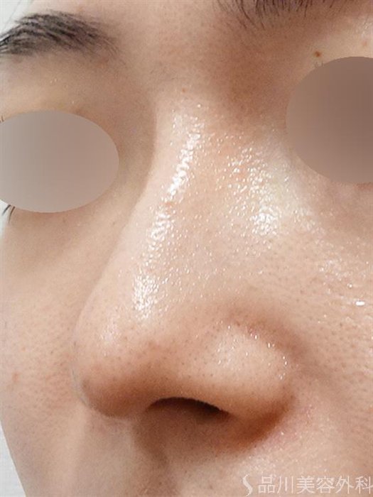 症例NO.51490のAFTER写真