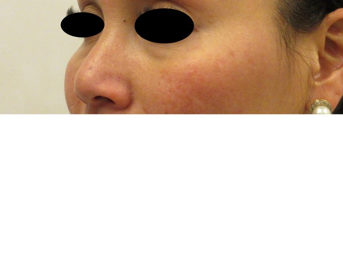 症例NO.75205のBEFORE写真