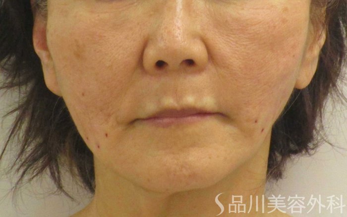 症例NO.65050のAFTER写真