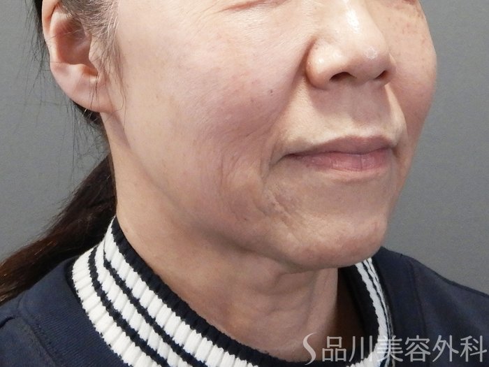 症例NO.74247のBEFORE写真