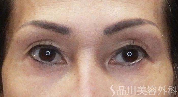 症例NO.69497のBEFORE写真