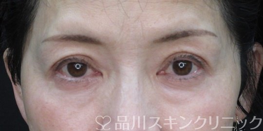 症例NO.72363のAFTER写真