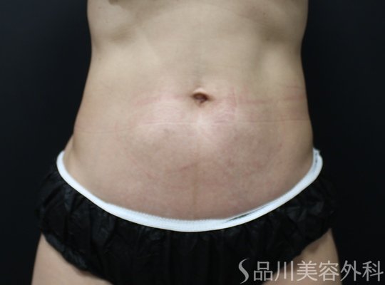 症例NO.75217のBEFORE写真