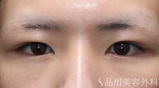 症例NO.75213のBEFORE写真