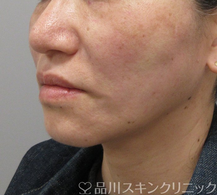 症例NO.73071のAFTER写真