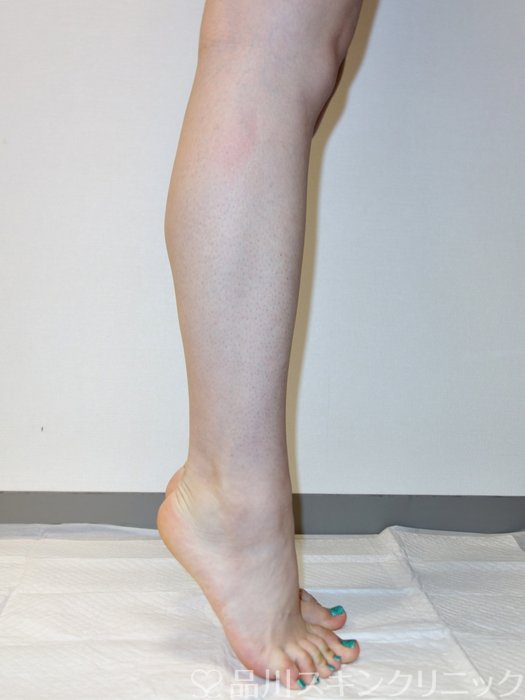 症例NO.73703のBEFORE写真